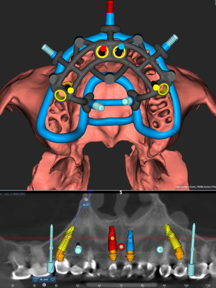 Guide Stackable (Ghid Chirurgical) [4]