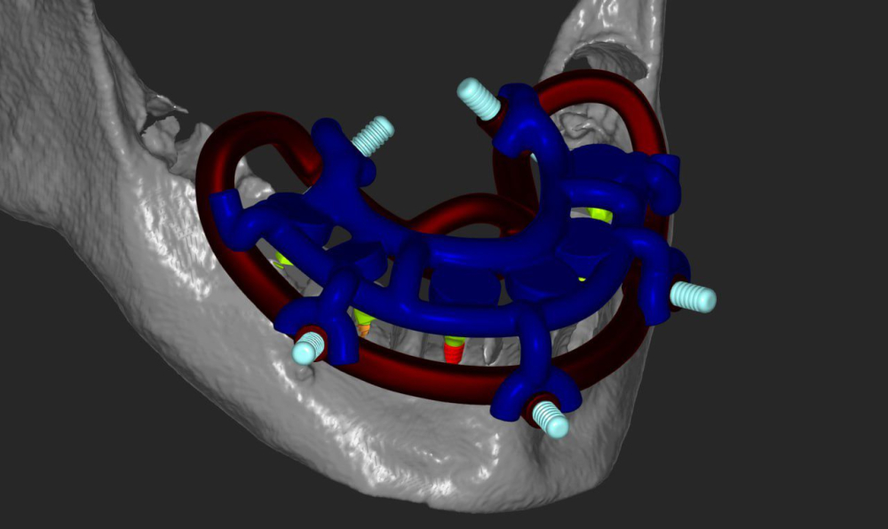 Guide Stackable (Ghid Chirurgical) [2]