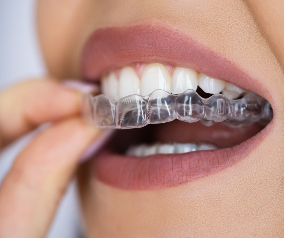 Gutiera de bruxism [2]