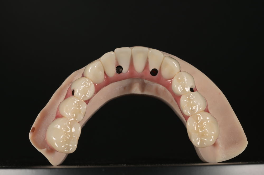 Lucrare Dentara Titan + Compozit (All on 4) [2]