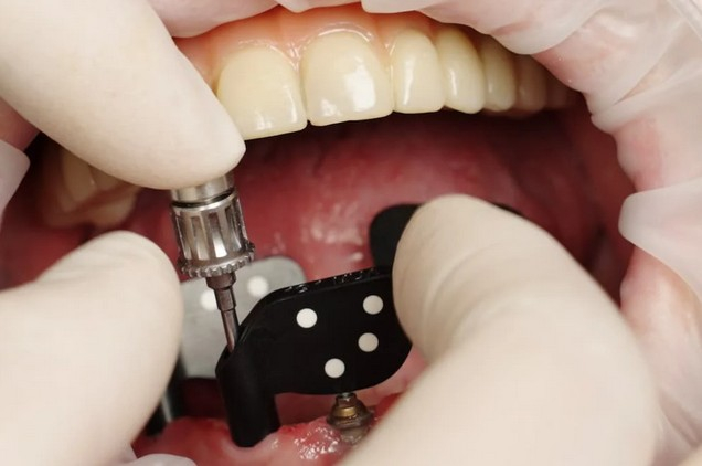 Scanare PIC Dental pentru All-on-4/6 (Fotogrametrie Digitala) [4]