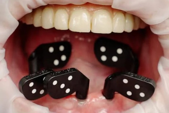 Scanare PIC Dental pentru All-on-4/6 (Fotogrametrie Digitala) [5]