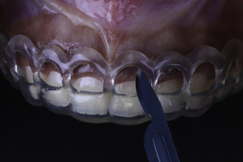 Auxiliare - GUIDE Gingival Complex (Ghid Gingivectomie)