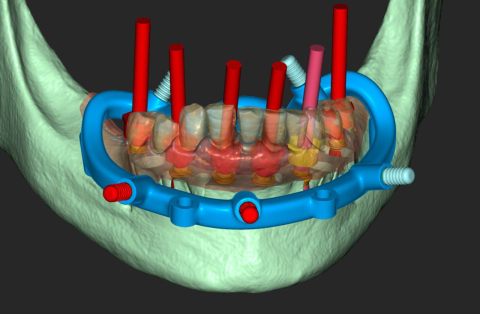 Guide Stackable (Ghid Chirurgical) [2]