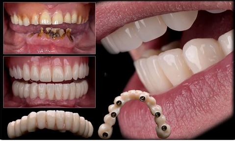 Protetica - Incarcare imediata PMMA Mulitstrat (Provizorie)