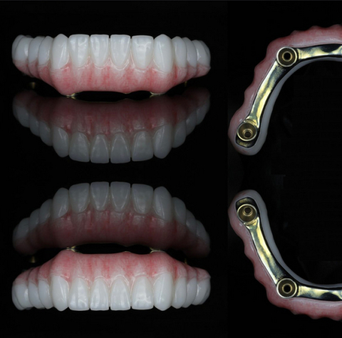 Incarcari Imediate - Incarcare imediata Titan + PMMA Multistrat (Provizorie)