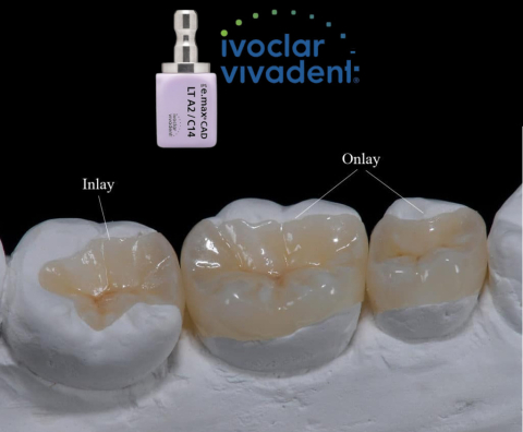 Inlay/Onlay - Incrustatie Onlay Ceramica E.MAX