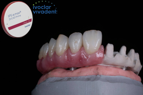 Protetica - Lucrare Dentara Peek + Zirconiu 3D  Ivoclar PRIME (All on 4)