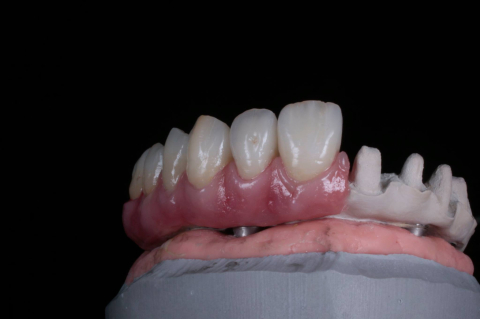 Protetica - Lucrare Dentara Peek + Zirconiu OneSmile (All on 4)