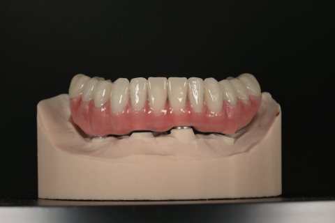 Protetica - Lucrare Dentara Titan + Compozit (All on 4)