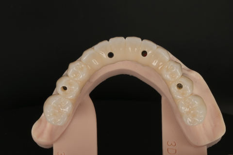 Lucrare Dentara Titan + Zirconiu 3D Ivoclar PRIME (All on 4) [2]