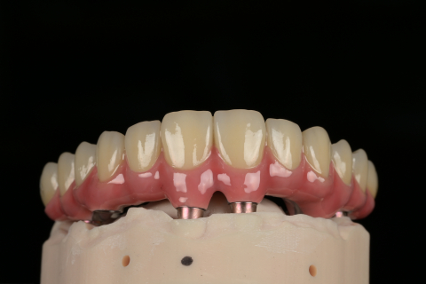 Protetica - Lucrare Dentara Titan + Zirconiu 3D Ivoclar PRIME (All on 6)