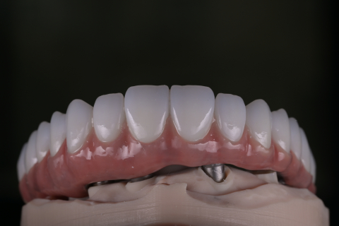 Protetica - Lucrare Dentara Titan + Zirconiu OneSmile (All on 6)