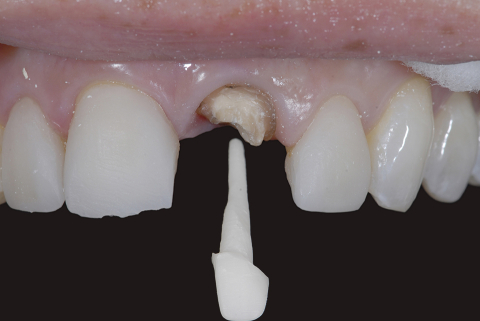 DCR - Pivot Zirconiu Opak (DCR)