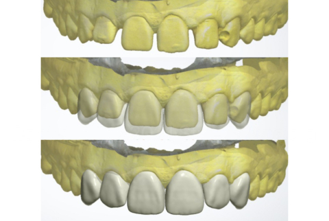 Auxiliare - Wax-Up Digital (Model 3D Printat)