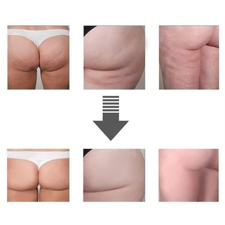 Set 12 ventuze terapeutice + pompa vacuum pentru masaj corp-fata si relaxare musculatura [4]