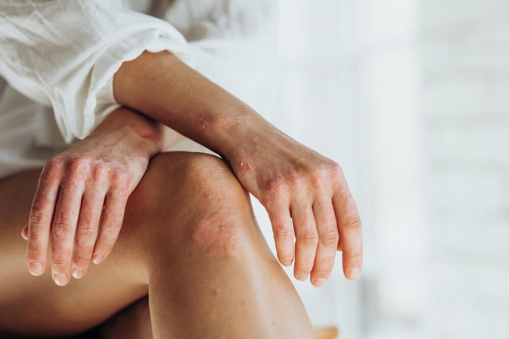 Eczema – cauze, tipuri și soluții naturiste și clasice pentru o piele sănătoasă