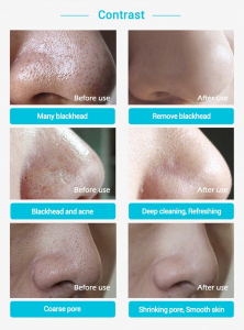 Masca pentru nas, tratament puncte negre, acnee [7]