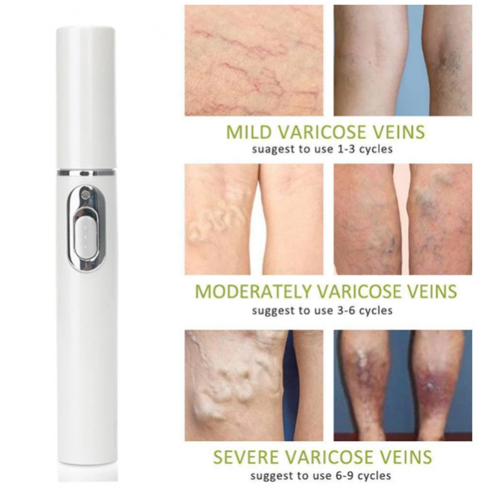 Dispozitiv cu lumina laser pentru tratarea varicelor si acneei, GMO, BlueLight Therapy, alb [7]