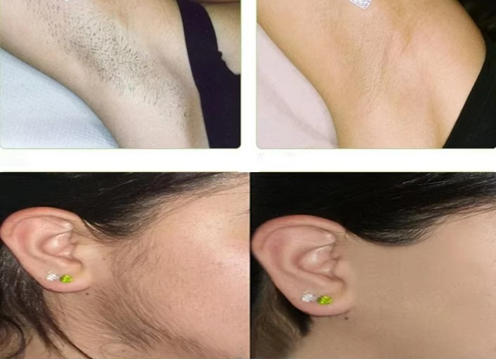 Epilator Laser Mijia pentru Femei, Îndepărtare Păr IPL Permanentă, Fără Durere, 999999 Flash-uri pentru Corp [7]