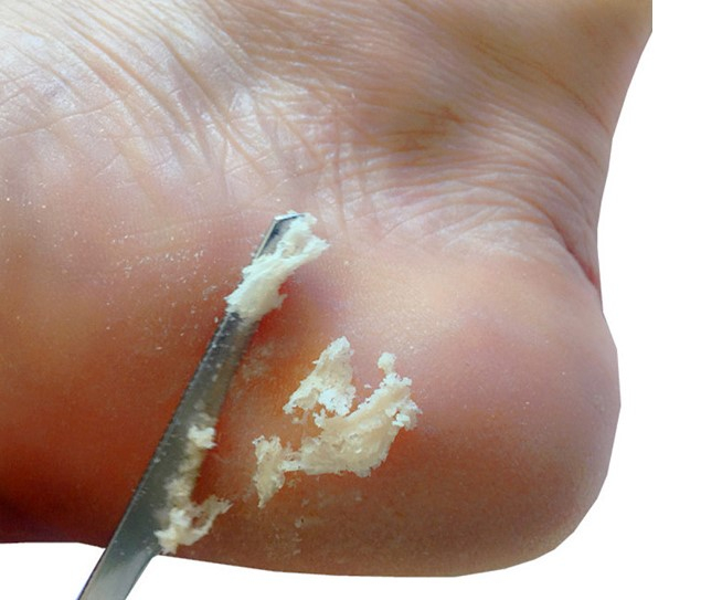 Instrument pentru curatarea calcaielor, EVNC, Foot Scraper [5]