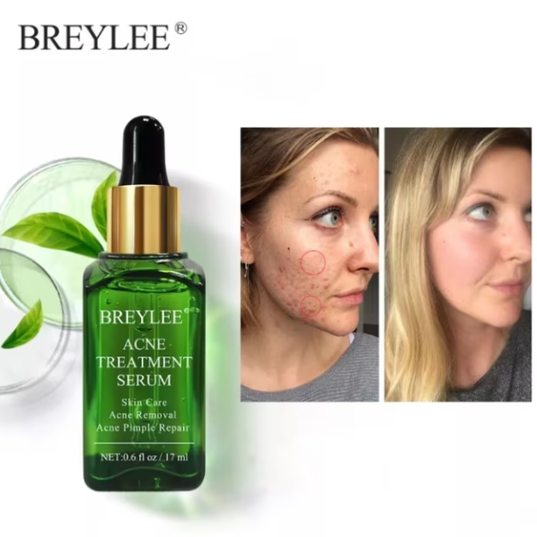 Ser anti-acnee Breylee, CRM, tratament pentru ingrijire ten, 17 ml [5]