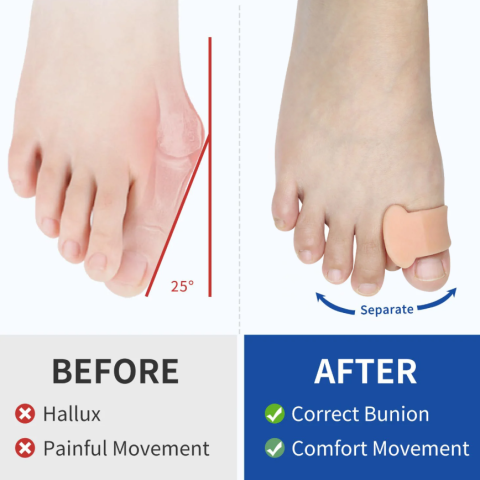 Set 2 buc Corector monturi hallux valgus din silicon, CRM,  separator degete picior, protector deget mare, suport ortopedic reutilizabil, unisex [1]