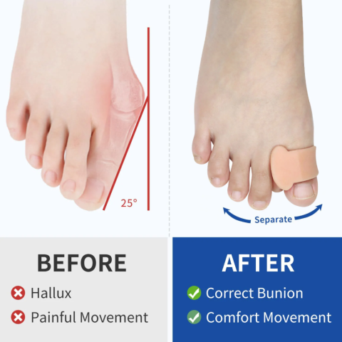 Set 2 buc Corector monturi hallux valgus din silicon, CRM,  separator degete picior, protector deget mare, suport ortopedic reutilizabil, unisex [9]