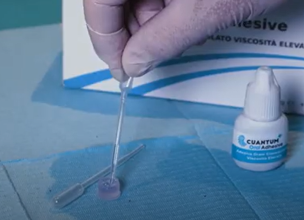 Situații utilizare pentru Cuantum Oral Adhesive și Cuantum Light Curing Oral Adhesive