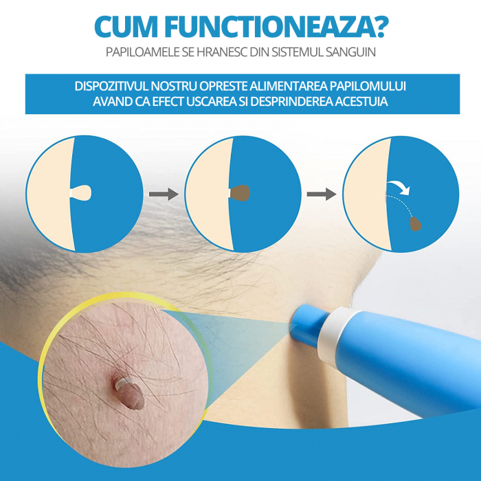 Dispozitiv Indepartare Papiloame prin Ligaturare, LittleDomi, pentru Fata, Gat, Corp, Dimensiuni 2-8mm, Alb/Abastru [3]