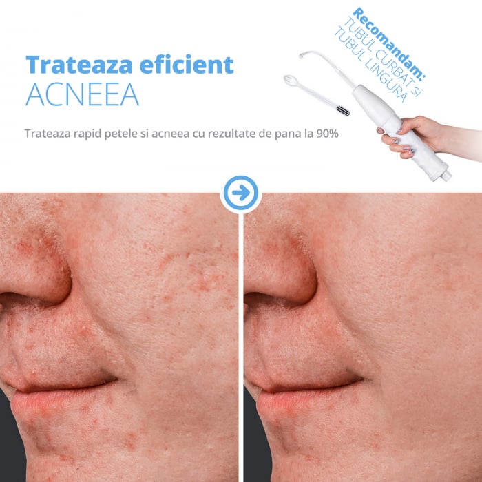 Electroderm, LittleDomi, Tratament cu Frecventa Inalta pentru Acnee, Riduri, Controlul Petelor, Cearcane, Ten, Par Seboreic, Stimulator Scalp, Infrumusetare, Biostimulare Faciala, Lifting, Alb [6]