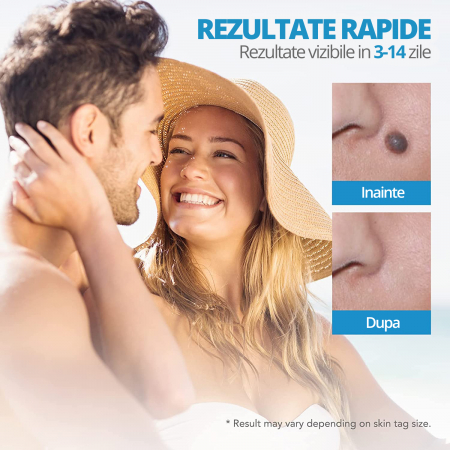 Dispozitiv Indepartare Papiloame prin Ligaturare, LittleDomi, pentru Fata, Gat, Corp, Dimensiuni 2-8mm, Alb/Abastru [3]