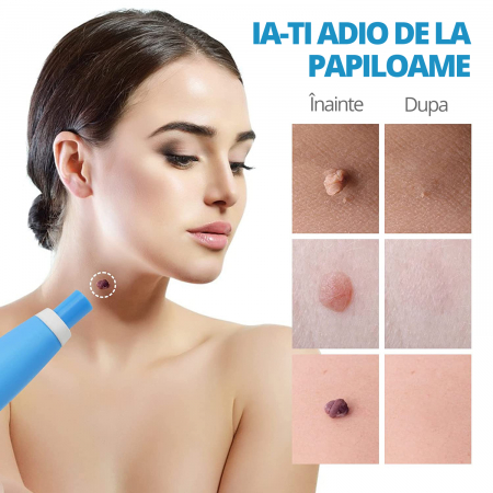 Dispozitiv Indepartare Papiloame prin Ligaturare, LittleDomi, pentru Fata, Gat, Corp, Dimensiuni 2-8mm, Alb/Abastru [1]