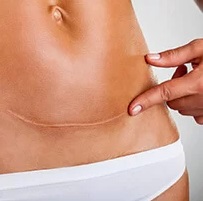 Descoperă secretul unei pielii fără urme cu crema pentru cicatrici!
