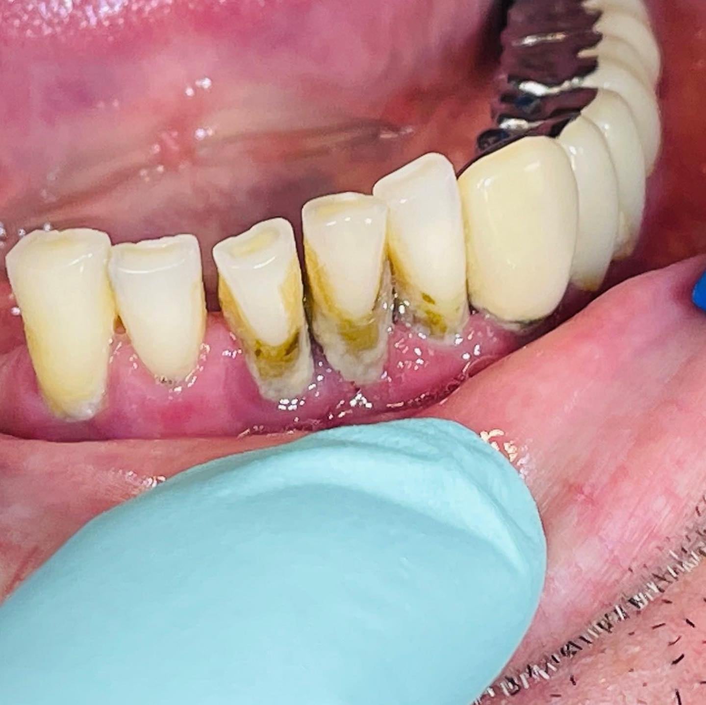 Tartrul dentar și igienizarea profesională