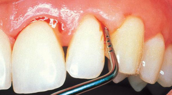 Care este tratamentul actual al parodontozei?