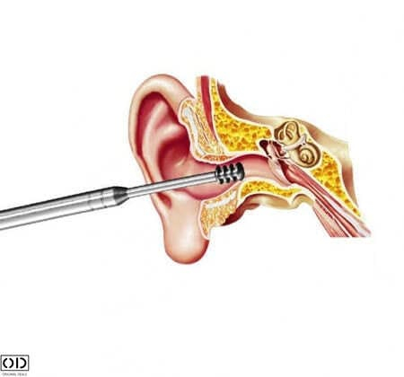 Set 6 Instrumente pentru Curatarea, Ingrijirea si Igiena Urechilor, din Otel Dermatologic [2]
