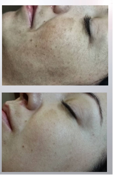 Tratament Phyt’Skin Rénov – Peeling Chimic & Regenerare celulara BIO [8]
