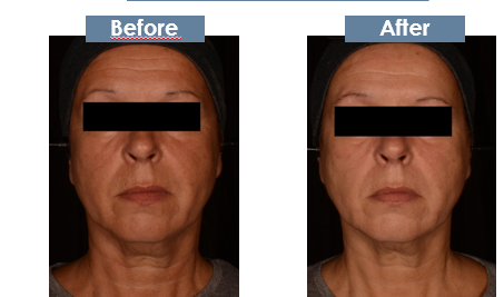 Tratament Phyt’Skin Rénov – Peeling Chimic & Regenerare celulara BIO [7]