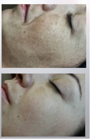 Tratament Phyt’Skin Rénov – Peeling Chimic & Regenerare celulara BIO [7]