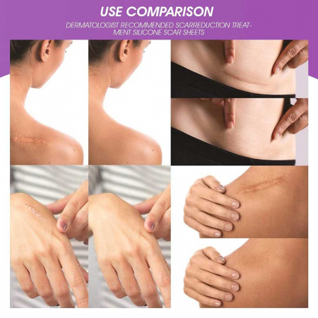 Benzi Premium de Silicon cu Gel pentru Cicatrici, 4 buc, Reutilizabile, 14.98 cm x 4.06 cm4