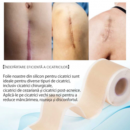 Rola Pansament Premium din Silicon Medical pentru Cicatrici, Reutilizabil, NOVA KISS®, 4 cm x 3.3 m3