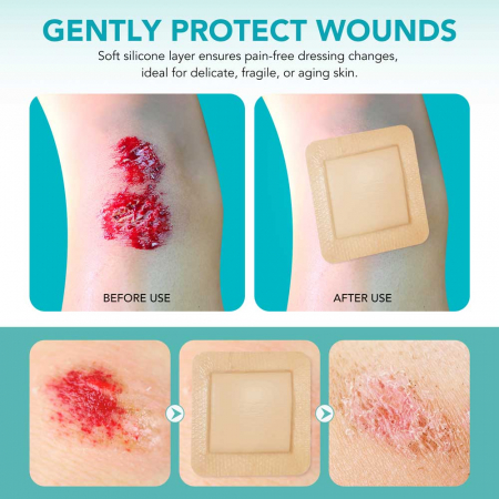 Comprese Premium pentru Cicatrici din Spuma de Silicon cu Argint si Margine Adeziva, 5 buc, 10 cm x 10 cm1