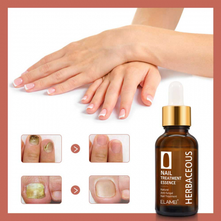 Tratament Antifungic Profesional pentru Unghii Deteriorate, 30 ml4