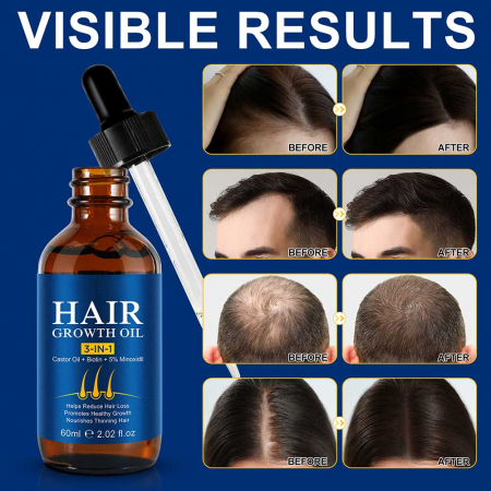 Ulei Premium 3 in 1 pentru Cresterea Parului cu Minoxidil, Biotina si Ulei de Ricin, 60 ml2