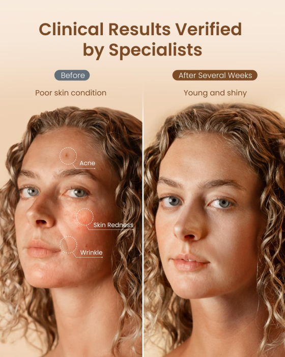 Masca faciala LED RENPHO Artemis Blush, 4 moduri de lumina, 432 LED-uri, terapie cu lumina rosie, albastra, verde si NIR, reincarcabila, silicon flexibil [4]