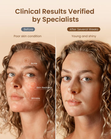 Masca faciala LED RENPHO Artemis Blush, 4 moduri de lumina, 432 LED-uri, terapie cu lumina rosie, albastra, verde si NIR, reincarcabila, silicon flexibil [3]