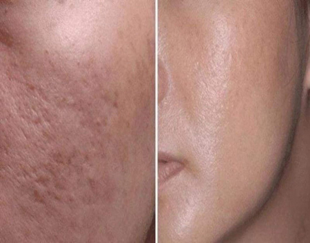 Aparat masaj facial Hydra Roller [4]
