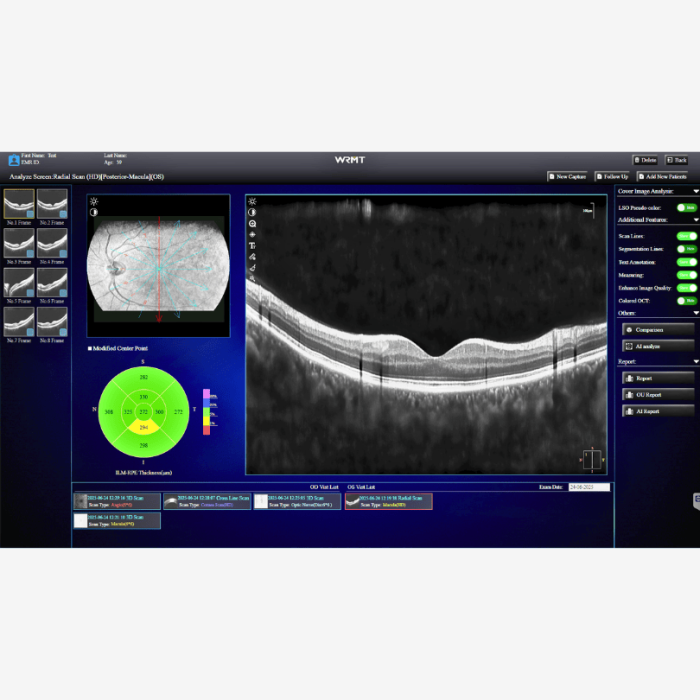OCT/A EYEFOS 1K cu AI, tomograf în coerență optică 4K pentru diagnostic retinian și glaucom [5]