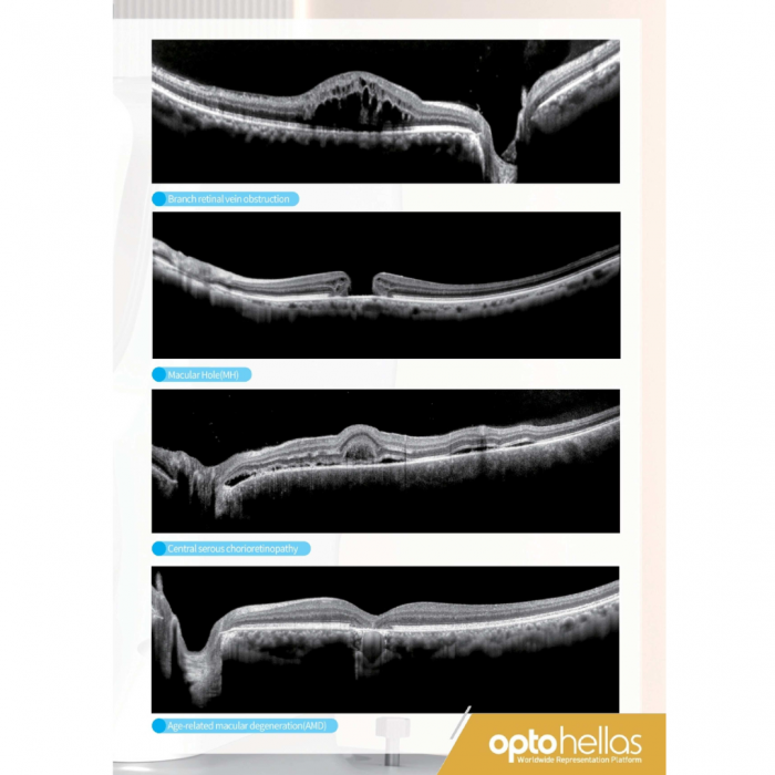 Tomograf în Coerență Optică Velite C1000 – OCT Ocular Profesionist [6]